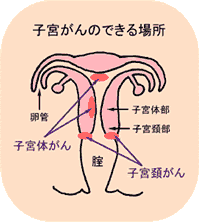 子宮がんのできる場所